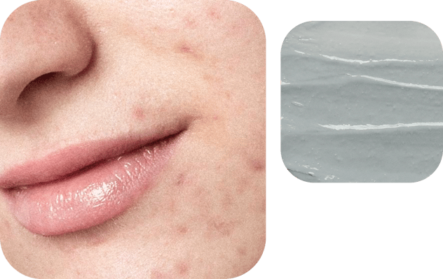 acne-care-skin-products