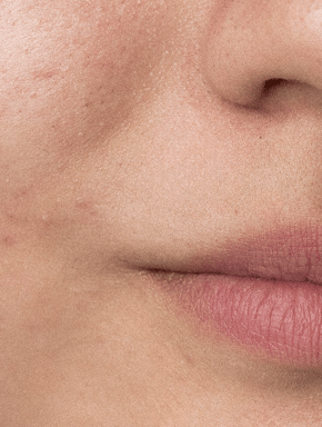 Coffret de soins pour peaux à imperfections